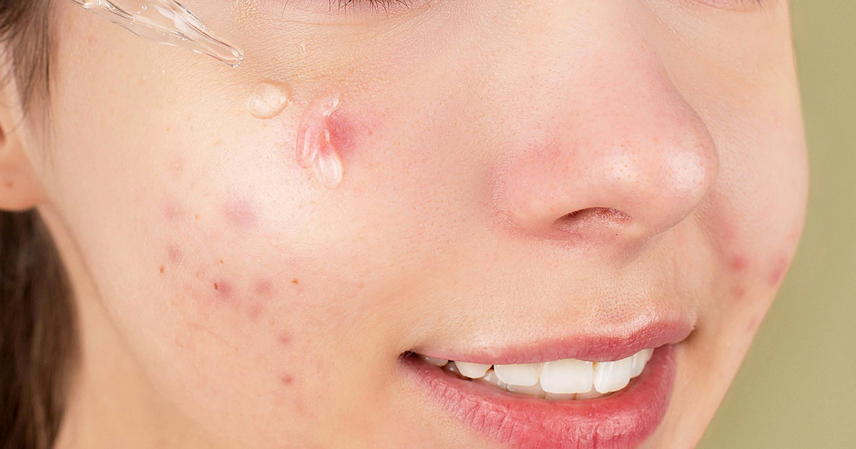 Allergy Skin Reation